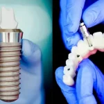 The Best Dental Implants in Los Angeles – Beauty, Comfort & Confidence in One