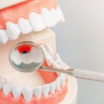 Transform Your Smile with Veneers in Converse, TX | KashiDental