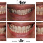 Lowest cost Invisalign Port Credit