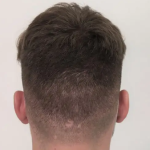 Why Donor Area Planning Is Critical in Hair Transplant?