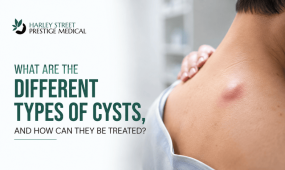 Close-up of a skin cyst or lump on a person's upper back and shoulder area, with a hand gently examining the raised bump, illustrating common cyst types and treatment options from Harley Street Prestige Medical.