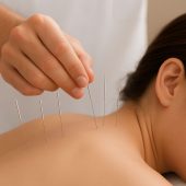Acupuncture